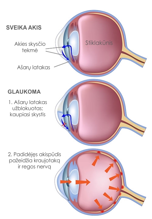 Glaukom ili očni tlak?